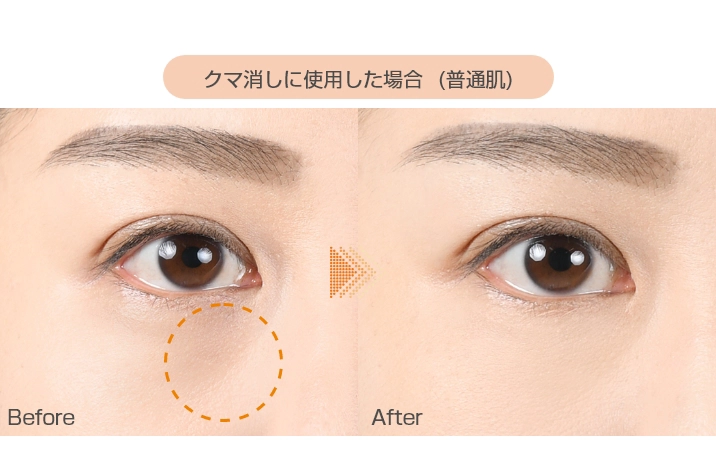 When used to remove dark circles (normal skin)