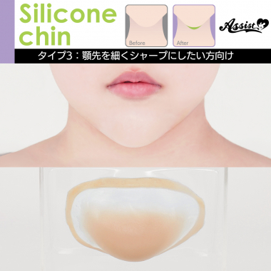Silicone Chin Type 3