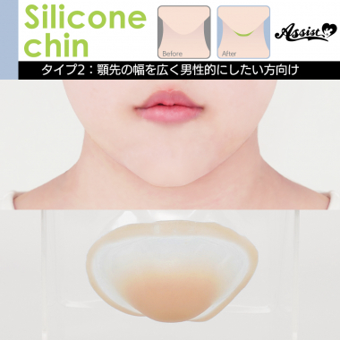 Silicone Chin Type 2